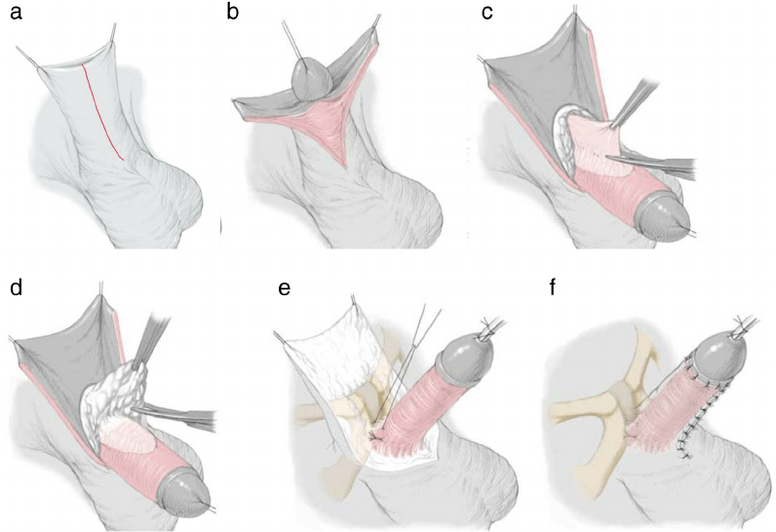 ligamentotomy le haghaidh méadú bod